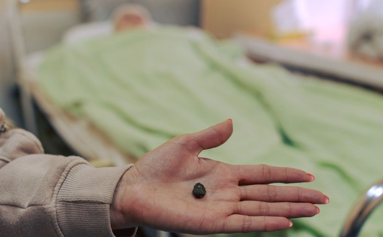 У Києві провели унікальну операцію, щоб врятувати поранену під час обстрілу багатоповерхівки дівчину